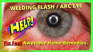 Welding Flash / Arc Eye  Best 11 Home Remedies