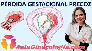 PÉRDIDA GESTACIONAL PRECOZ (ABORTO ESPONTÁNEO): CAUSAS y DIAGNÓSTICO.  - Ginecología y Obstetricia -