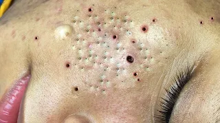 Loan Nguyen Acne spa #574