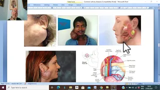 Head and neck surgery in Arabic 10 ( Pleomorphic adenoma) , by Dr. Wahdan