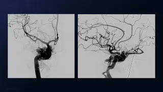 Pterional Craniotomy for Clip Ligation of a Sphenoparietal Sinus Dural Arteriovenous Fistula