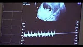 Early Pregnancy Viability Scan (7 Weeks - 11 Weeks)