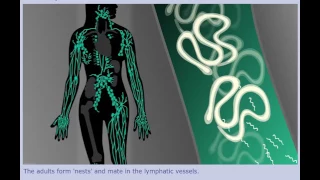 Lymphatic Filariasis (Elephantiasis) - Life Cycle