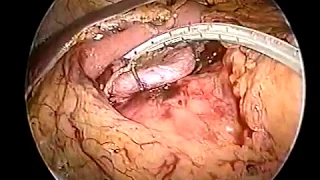 1998 | Laparoscopic Spleen-Preserving Distal Pancreatectomy