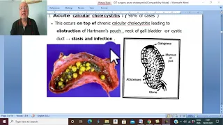 Biliary  disorders in Arabic 8 ( Acute Cholecystitis , part 1 ) , by Dr. Wahdan