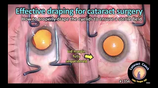 CataractCoach 1356: effective draping for cataract surgery