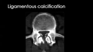 Spinal imaging Degenerative diseases II   DRE 3   Dr Mamdouh Mahfouz 720p