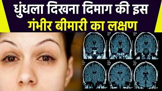 धुंधला दिखना Brain Tumor Symptoms , लक्षण पता चलने पर तुरंत कराए जांच |Boldsky*Health