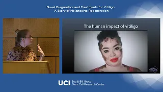 Novel Diagnostics and Treatments for Vitiligo