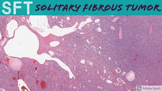 Solitary Fibrous Tumor (SFT) (formerly known as Hemangiopericytoma): 5-Minute Pathology Pearls