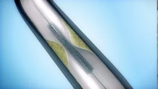 Stent animation