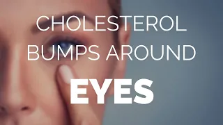 Cholesterol bumps around eyes, help and advice