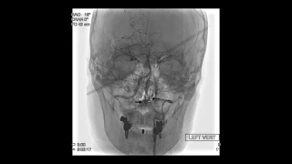 Surgical treatment of previously embolized craniocervical junction dural arteriovenous fistula