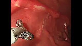 Removal of Anisakis Larvae