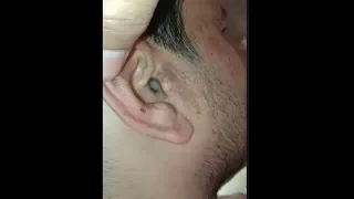 How to remove insects to ear at home ! insects removed to ear