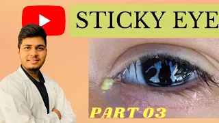 आखों का चिपकना बच्चे या बड़े सबका होगा सही । sticky eyes full treatment