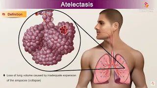 Atelectasis : Etiology, Clinical Features, Pathology, pathophysiology, Diagnosis, and Treatment