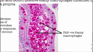 Whipple’s disease | Pathology cases | USMLE Step 1