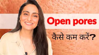 Open pores | पॉर्ज़ हटाने के तरीक़े  | Large open pores| serum, cream | त्वचा के डॉक्टर का सुझाव