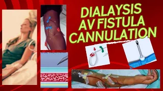 Dialysis Cannulation | Dialysis Cannulation Video | Dialysis Cannulation Procedure | Avf Cannulation