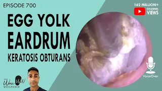 700 - Egg Yolk Eardrum & Keratosis Obturans