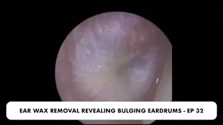 🔴EARDRUM ABOUT TO EXPLODE! 💥EAR WAX REMOVAL - EP 32