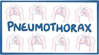 Pneumothorax - causes, symptoms, diagnosis, treatment, pathology