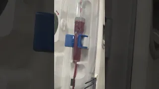 Máquina de HDF-Hemodiafiltração fazendo a infusão da solução de hdf, para fazer o arraste !!