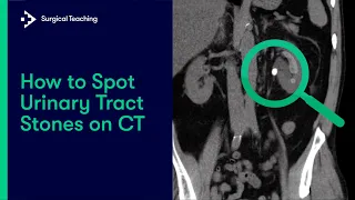 Urinary Tract Stones | How do we Diagnose them on CT Scans?