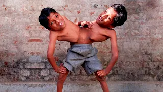 UNUSUAL Conjoined Twins You Won't Believe Exist