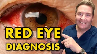 RED EYE: How to diagnose, differentiate and treat red eye & pink eye for primary care doctors