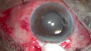 Cataract With CORNEAL OPACITY - SICS Live Stream