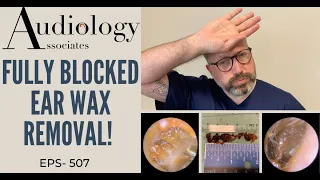 FULLY BLOCKED  EAR WAX REMOVAL - EP507