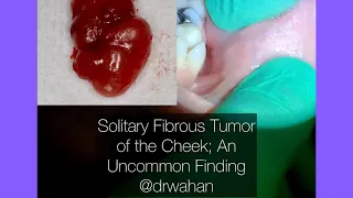 Solitary Fibrous Tumor of the Cheek: A Step by Step Excision Video @drwahan