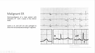 early repolarization