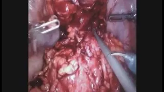 Robotic Ileocecal Resection with Enterovesicular Fistula Takedown