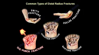 wrist fractures, symptoms, examination, diagnosis and treatment.