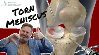 Over 55 with knee pain due to a torn meniscus... should you have it scoped? | A NEW STUDY