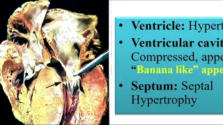 Cardiomyopathy (Hypertrophic and Restrictive)