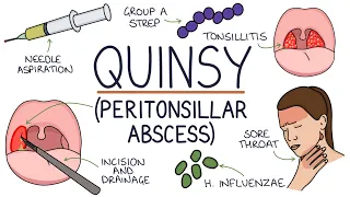 Understanding Quinsy (Peritonsillar Abscess)