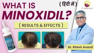 What is Minoxidil and How its Help in Hair Growth ? | Is Minoxidil Safe ? | Results & Side Effects