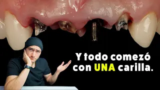 Perdió 4 dientes por hacerse UNA Carilla Dental. Su historia