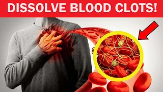 12 Foods That Dissolve Blood Clots Naturally !