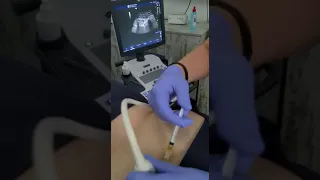 Ultrasound guided PRP sacroiliac joint injection .