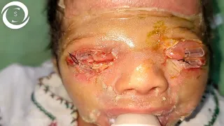 Tarsorrhaphy for Congenital eversion of upper eyelids