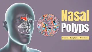 Nasal Polyps - Why do they appear and Treatment Options?