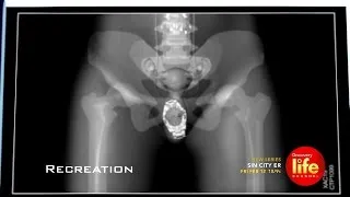 Stolen Rolex Found On X-Ray