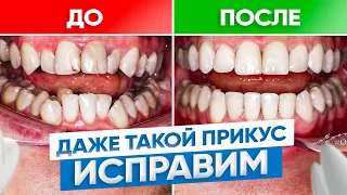 Даже из таких кривых зубов можно сделать идеальный прикус. Брекеты ДО и ПОСЛЕ