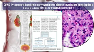 COVID-19 assoziierte Nephritis   Laborwerte als frühes Warnsignal