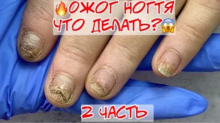 🔥 Burn of the nail plate 😱😫 part 2 🔥 Onycholysis of nails